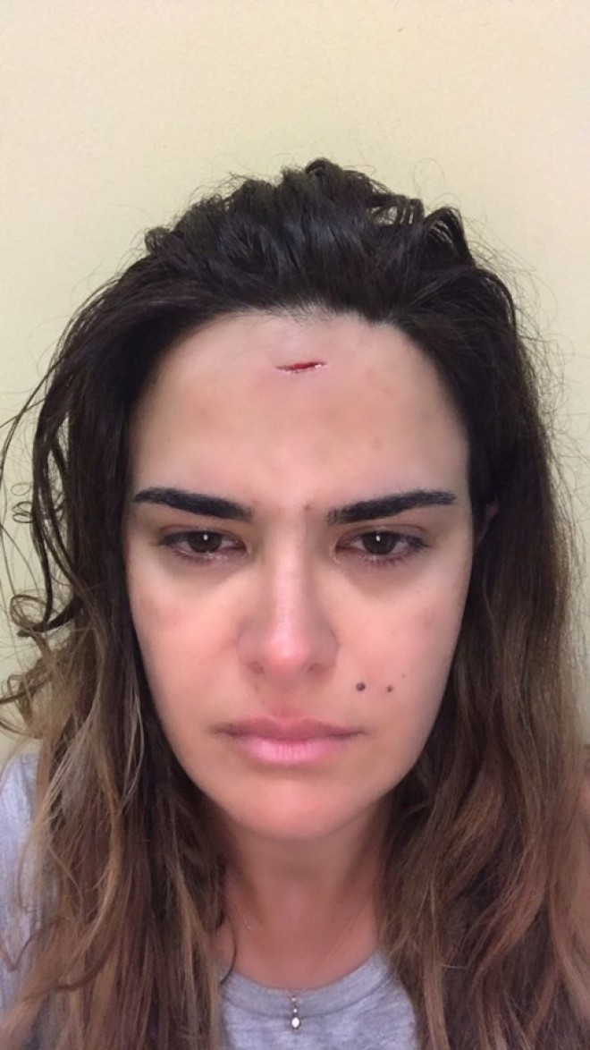 Bikinili videosunu sildirmək istədi, alnı yarıldı